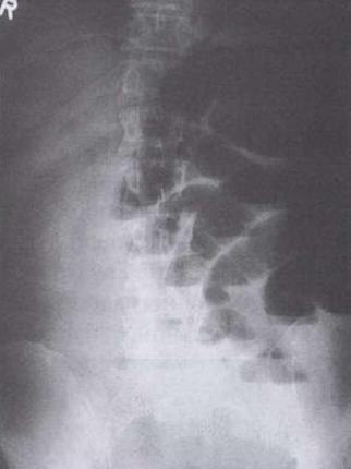 Описание: рентгенологическая картина кишечной непроходимости